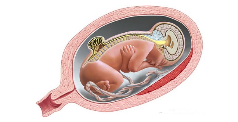 عدد NTDs در غربالگری دوم