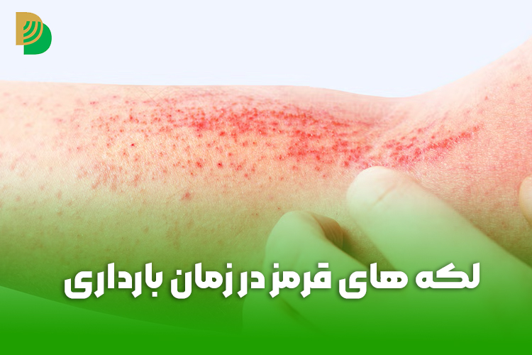 لکه های قرمز روی پوست بدون خارش در بارداری
